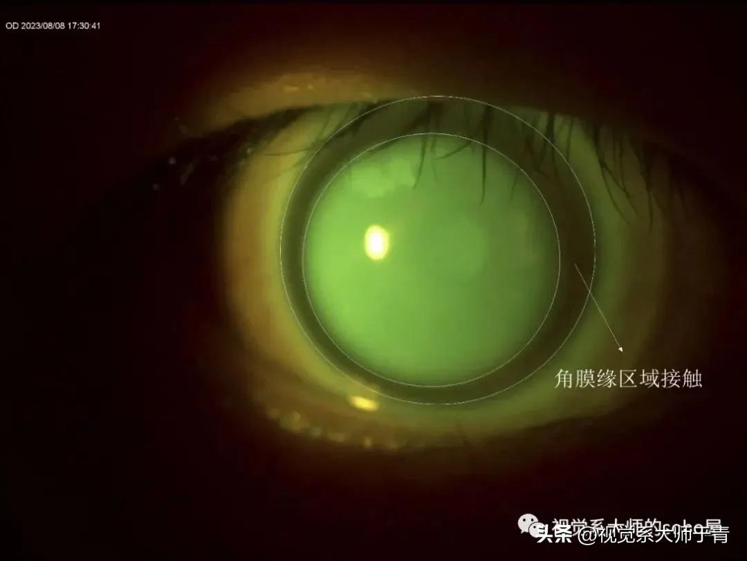 巩膜镜的验配技巧及案例分享,试戴巩膜镜成功率高不高