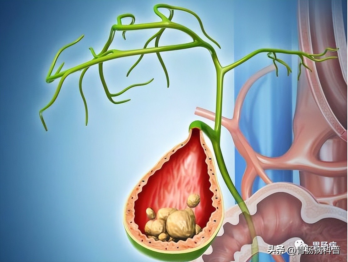 慢性胆囊炎吃药能痊愈吗,慢性胆囊炎怎么治疗可以彻底治愈