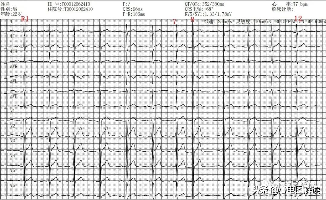 房性早搏二联律的解释,房性早搏二联律正常吗