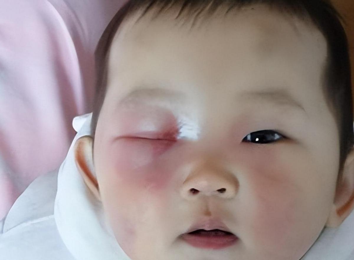 20分钟孩子眼球被融化了,男孩眼睛被融化了