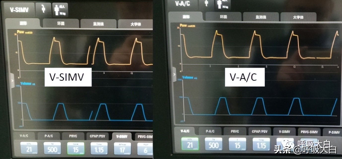 呼吸机设置：呼吸频率+吸呼比