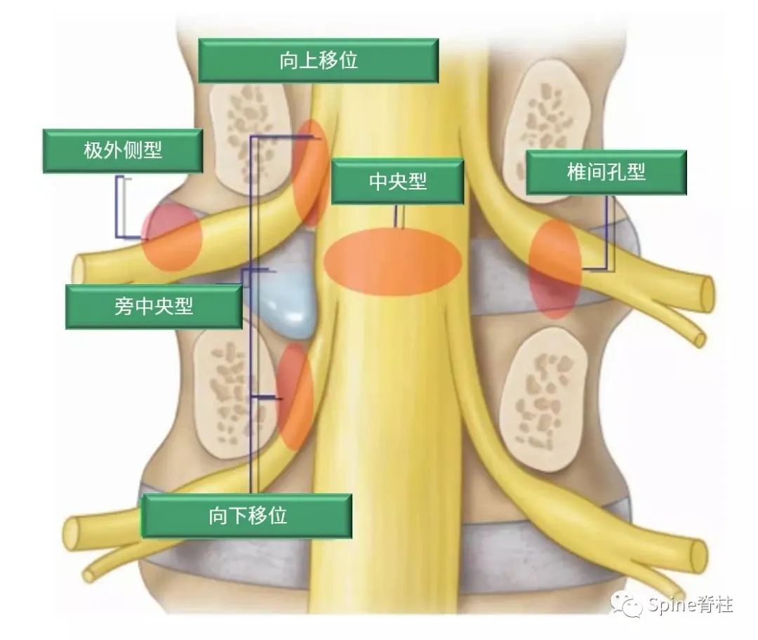 腰椎间盘突出症状表现,腰椎间盘突出症疼痛最佳止痛方法