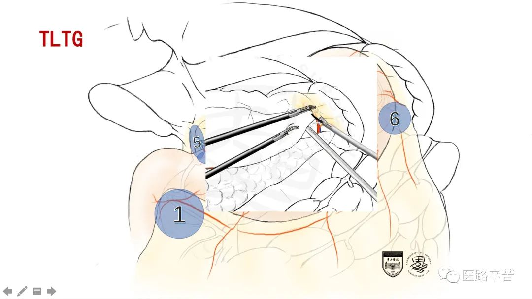 全腹腔镜胃癌根治术，学习大咖怎么清扫淋巴结