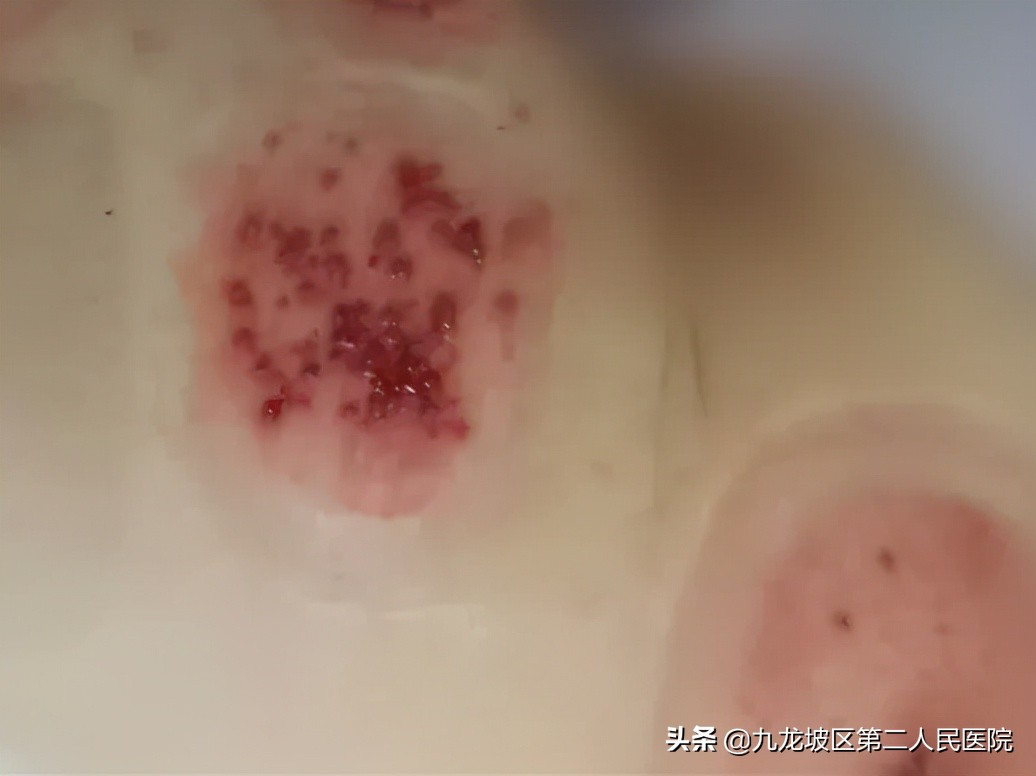 58岁阿姨臀部长疱疹，医生用火针放血、隔物灸疗居然治好