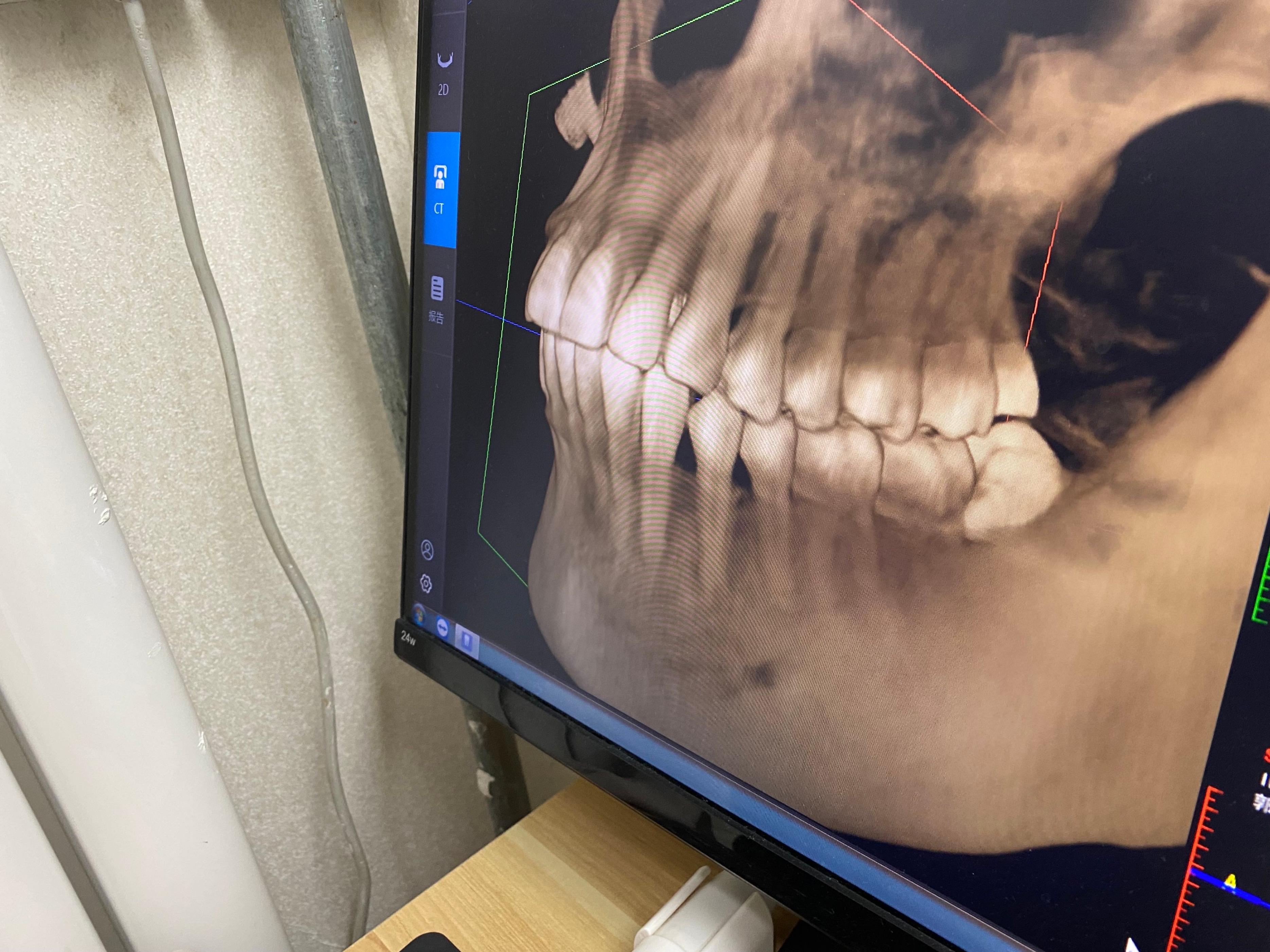 拔智齿拆线后隐隐作痛,拔智齿后痛多久算正常