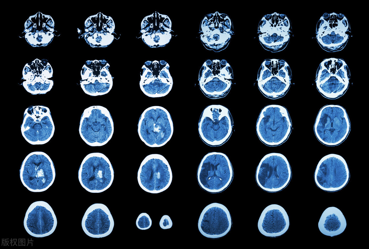 家里老人脑出血应该怎样安慰,家人脑出血自己如何调整心情
