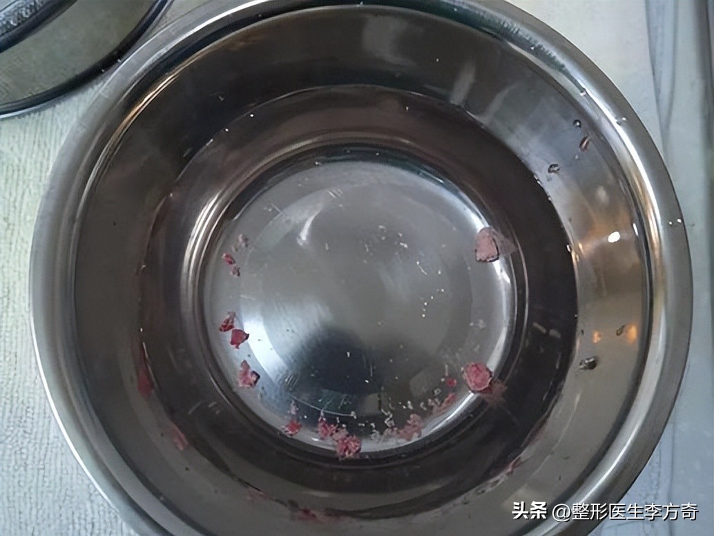 为什么骨粉填充不建议做,面部注射骨粉危害