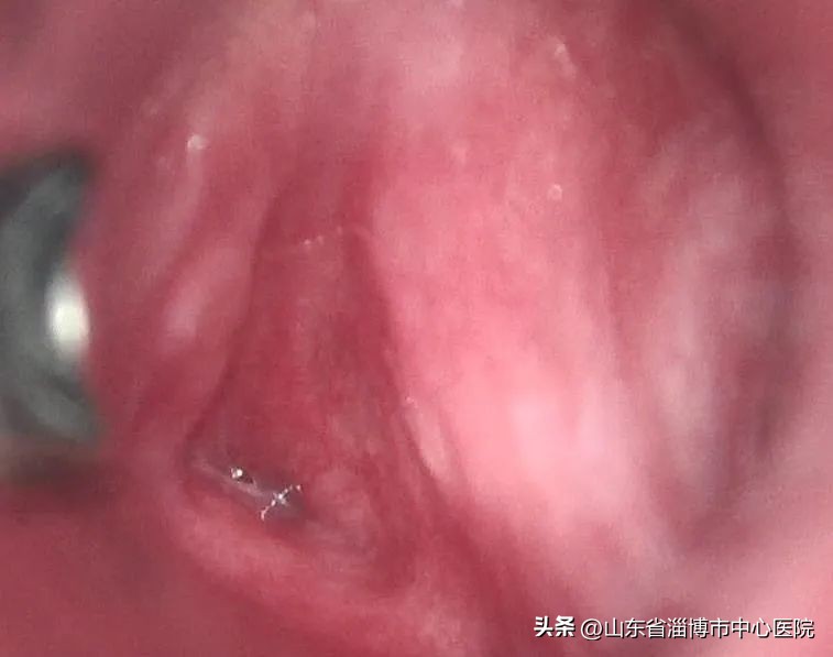 咽喉微创手术县级医院能否做,咽喉部的微创手术