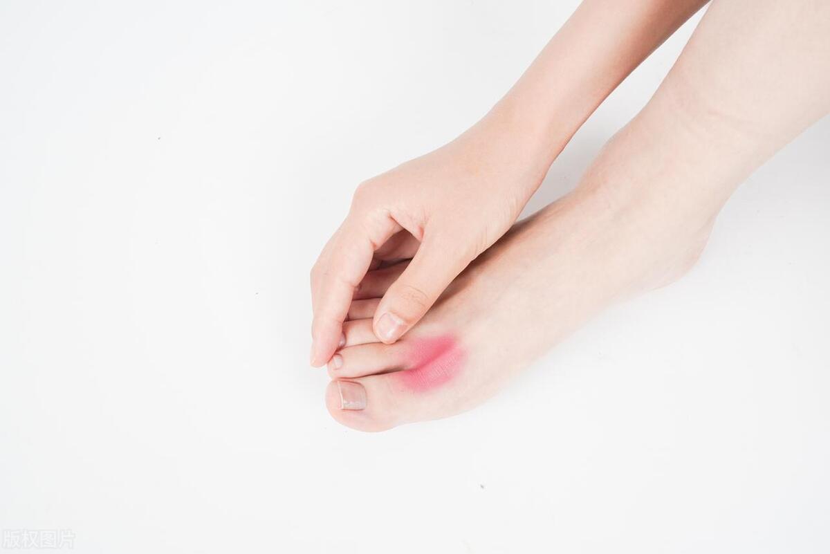 鸡眼最后的根怎么处理,鸡眼又疼又痒怎么处理