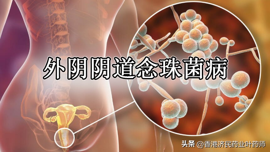 复发性外阴念珠菌怎么治疗最好,念珠菌性外阴炎怎么预防