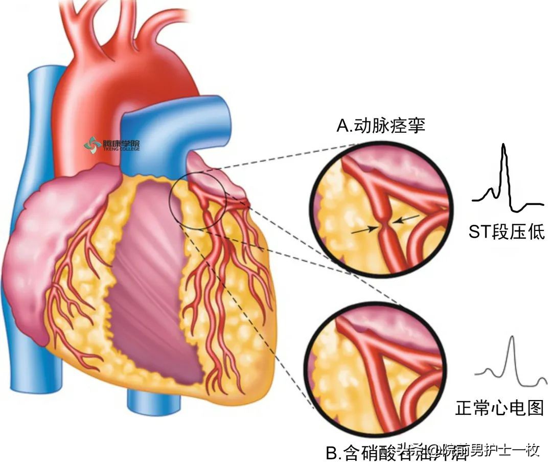关于心绞痛护理措施的图片,冠心病心绞痛救治成功率