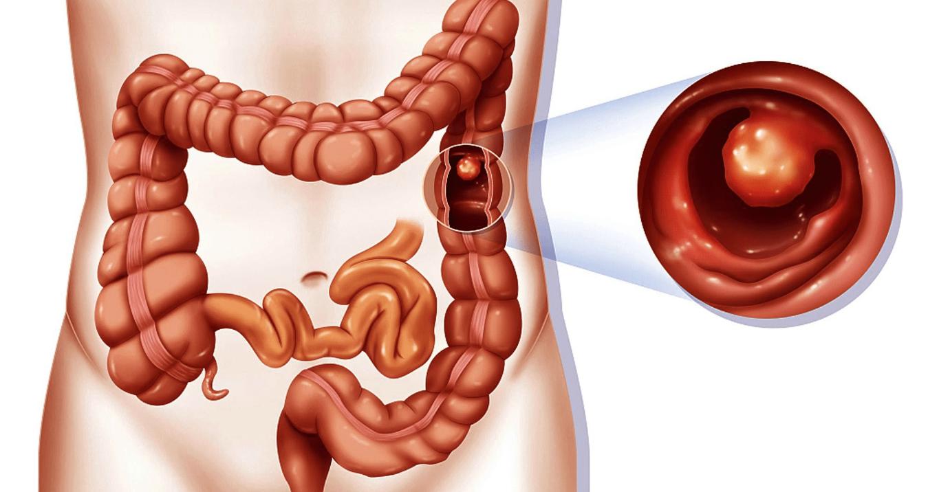 化痰散结，这几味虫类药材，助你“吃掉”肠息肉