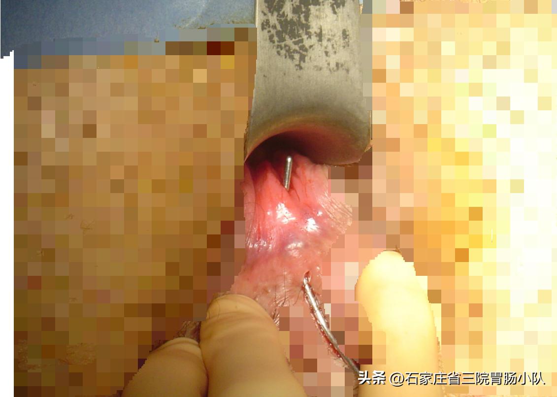 多久发展成复杂肛瘘,复杂肛瘘手术成功率