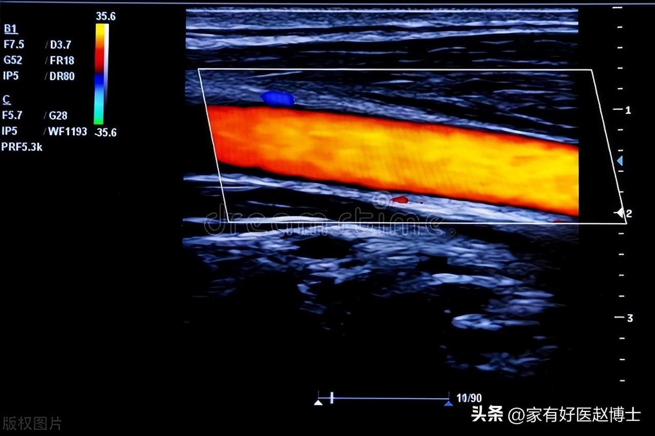 超声检查到的斑块多大才危险,超声检查颈动脉完全闭塞准吗