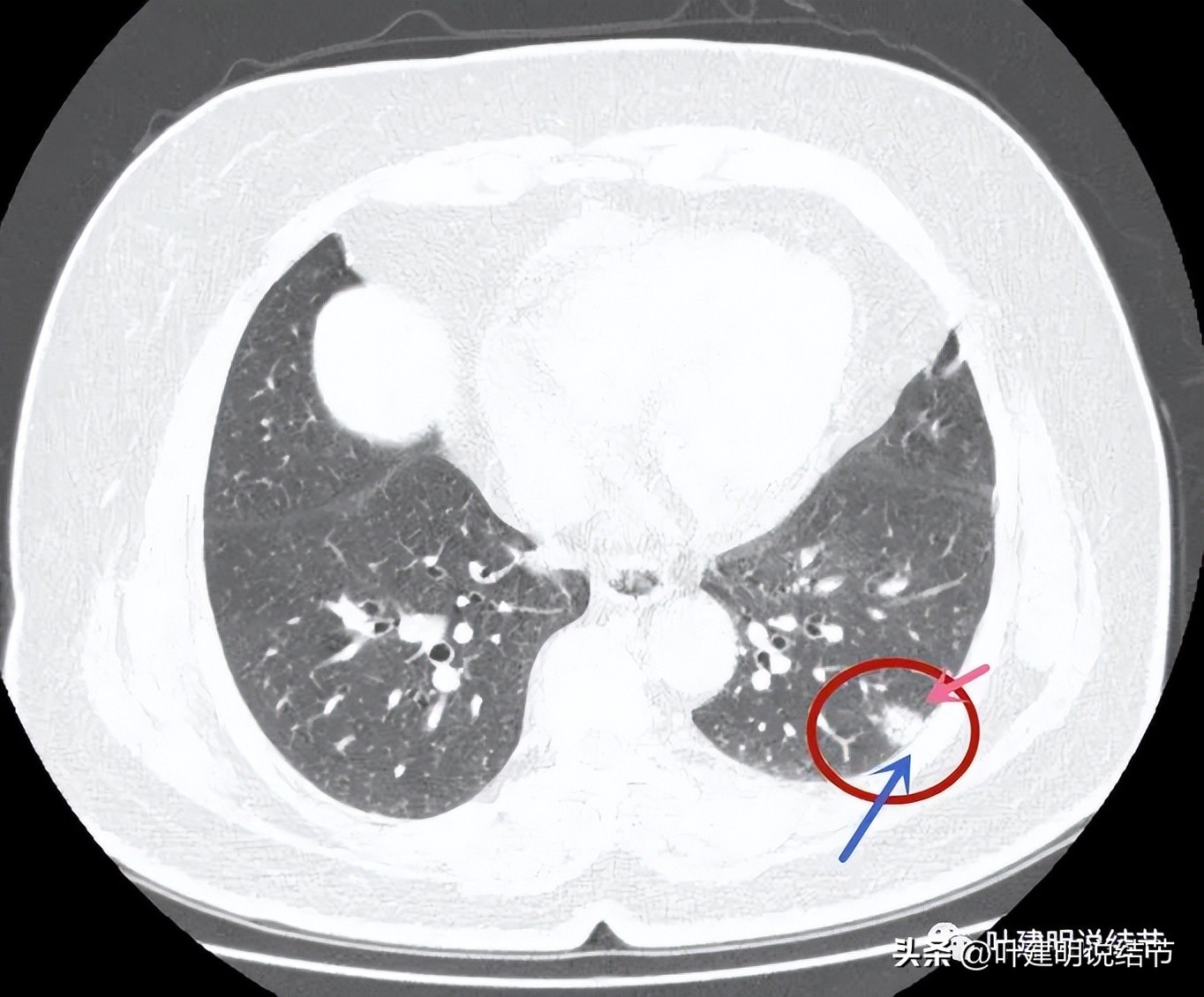 肺结节实性为什么建议抗炎治疗,肺上实性结节抗炎后变成空洞