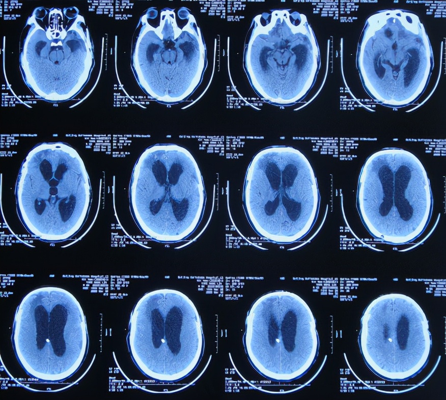 脑外伤后硬膜下积液颅骨修补,颅骨修复手术失败导致脑积水
