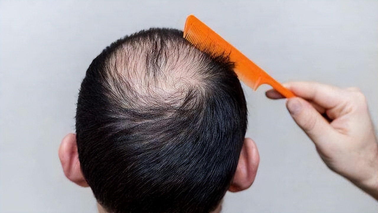 脱发为什么都是从头顶先秃,脱发为什么先从头顶脱