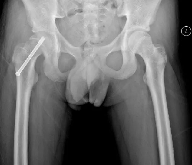 小儿骨科科普类短视频,股骨头骨骺滑脱中医手法治疗