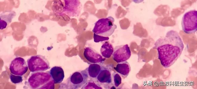 化疗加造血干细胞移植,化疗移植