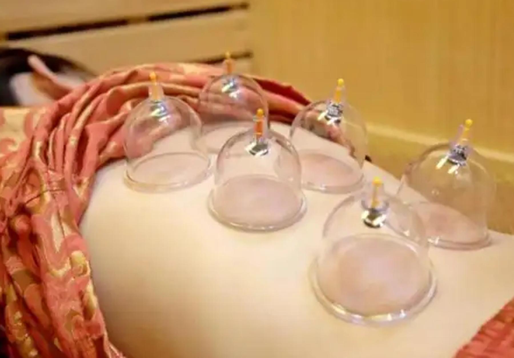 女子拔罐二度烧伤后续,女子拔火罐被烧伤后续