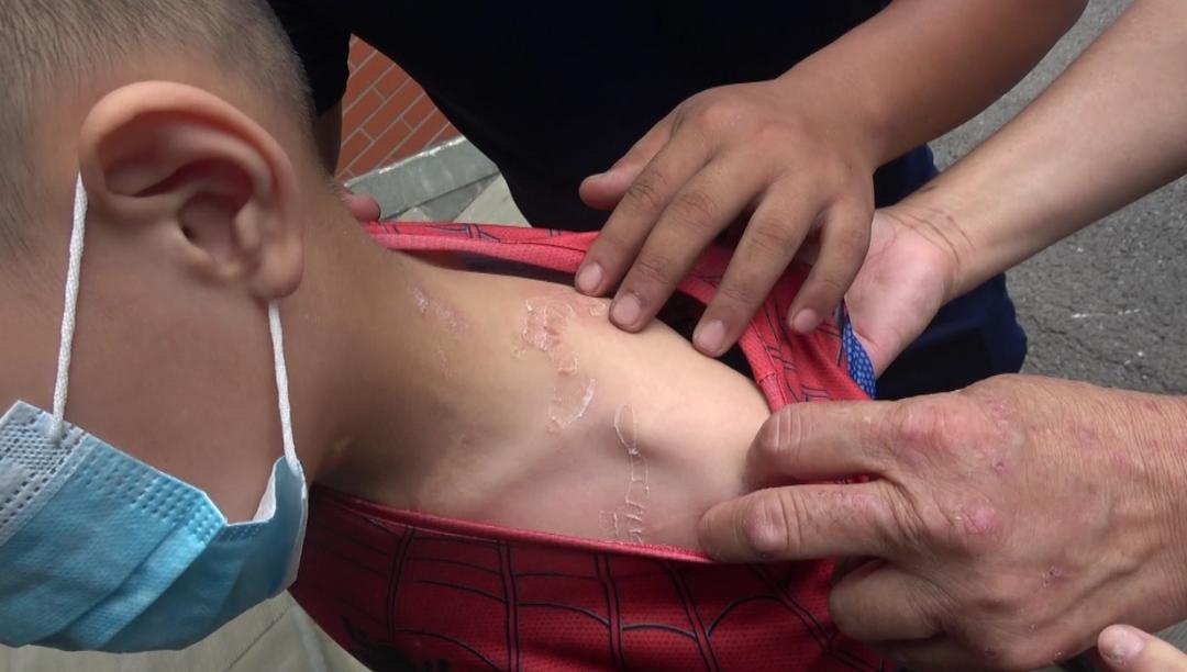 男孩被502胶粘住眼睛,一个小男孩被502胶粘住了