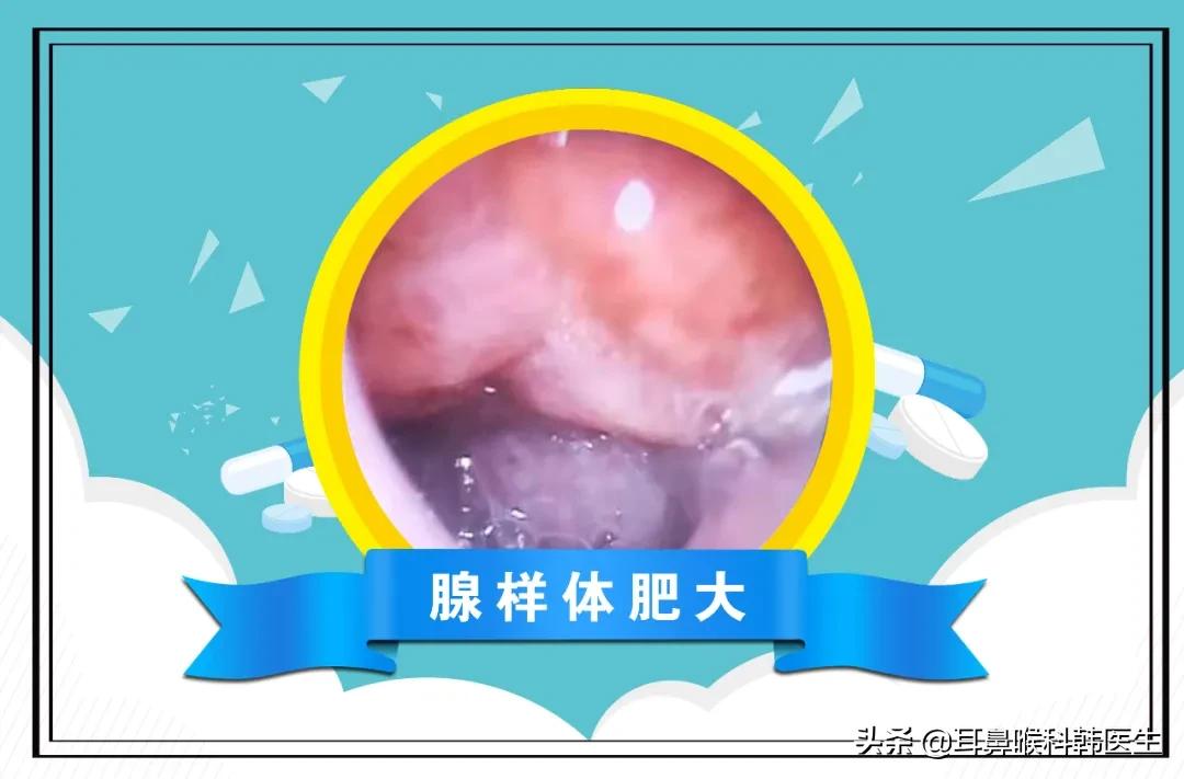 耳鼻喉科电子内窥镜能检查什么病,耳鼻喉内窥镜详细操作流程考核表