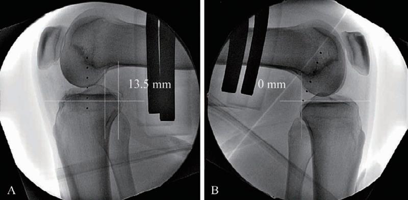 膝关节前交叉韧带损伤怎么治,十字交叉韧带损伤如何解决