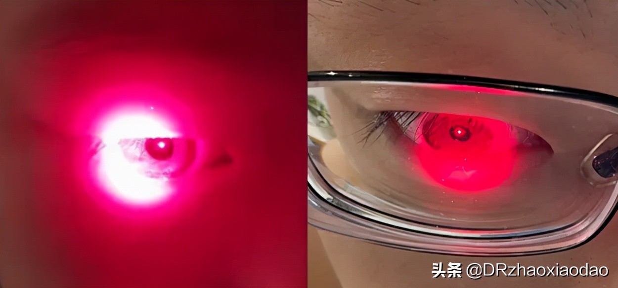 文献解读：红光治疗在近视防控中的作用