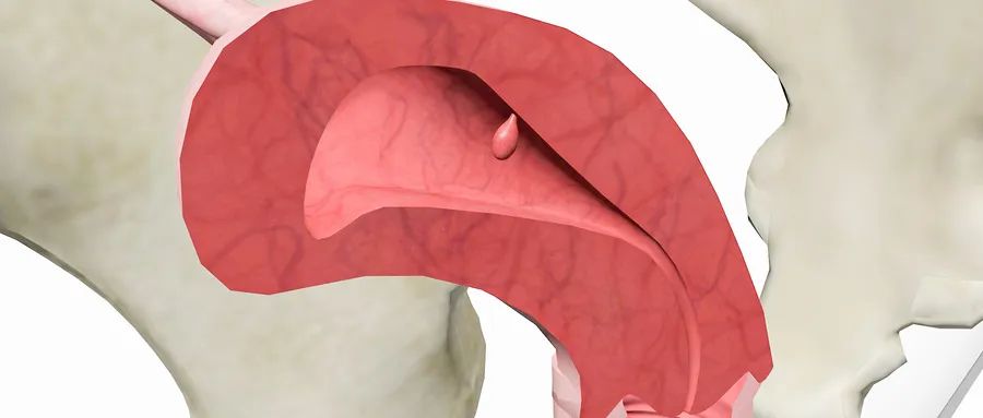 宫颈息肉和巧克力囊肿能一起做吗,子宫囊肿巧克力囊肿中药治疗