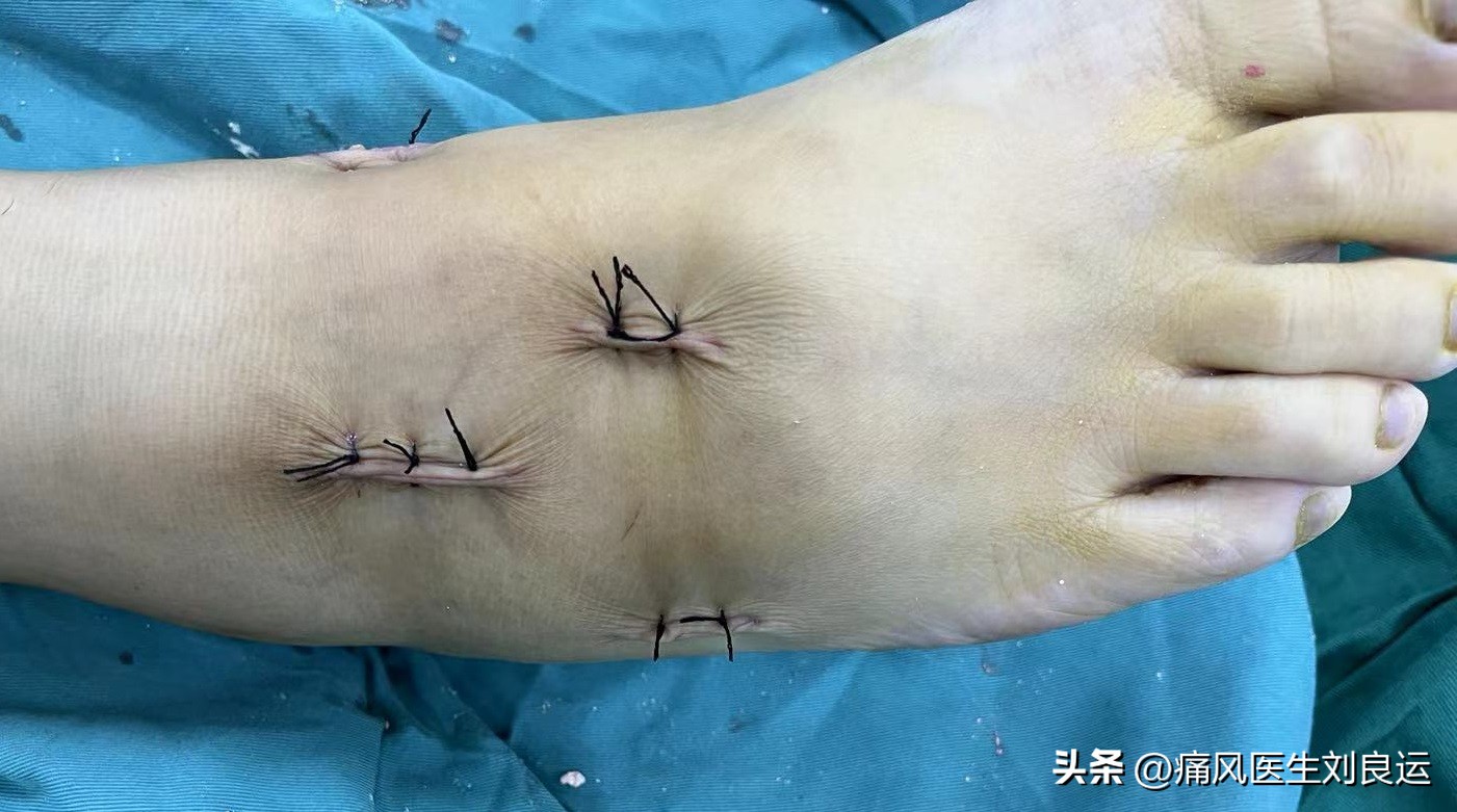 痛风病人用什么方法能治好痛风,痛风治疗最好的方法有什么