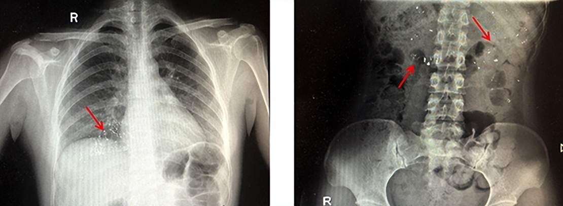 孩子误吞水银完整视频,小孩误吞水银怎么办