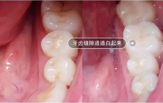 电动牙刷怎么刷牙不伤牙,电动牙刷几天用一次不伤牙