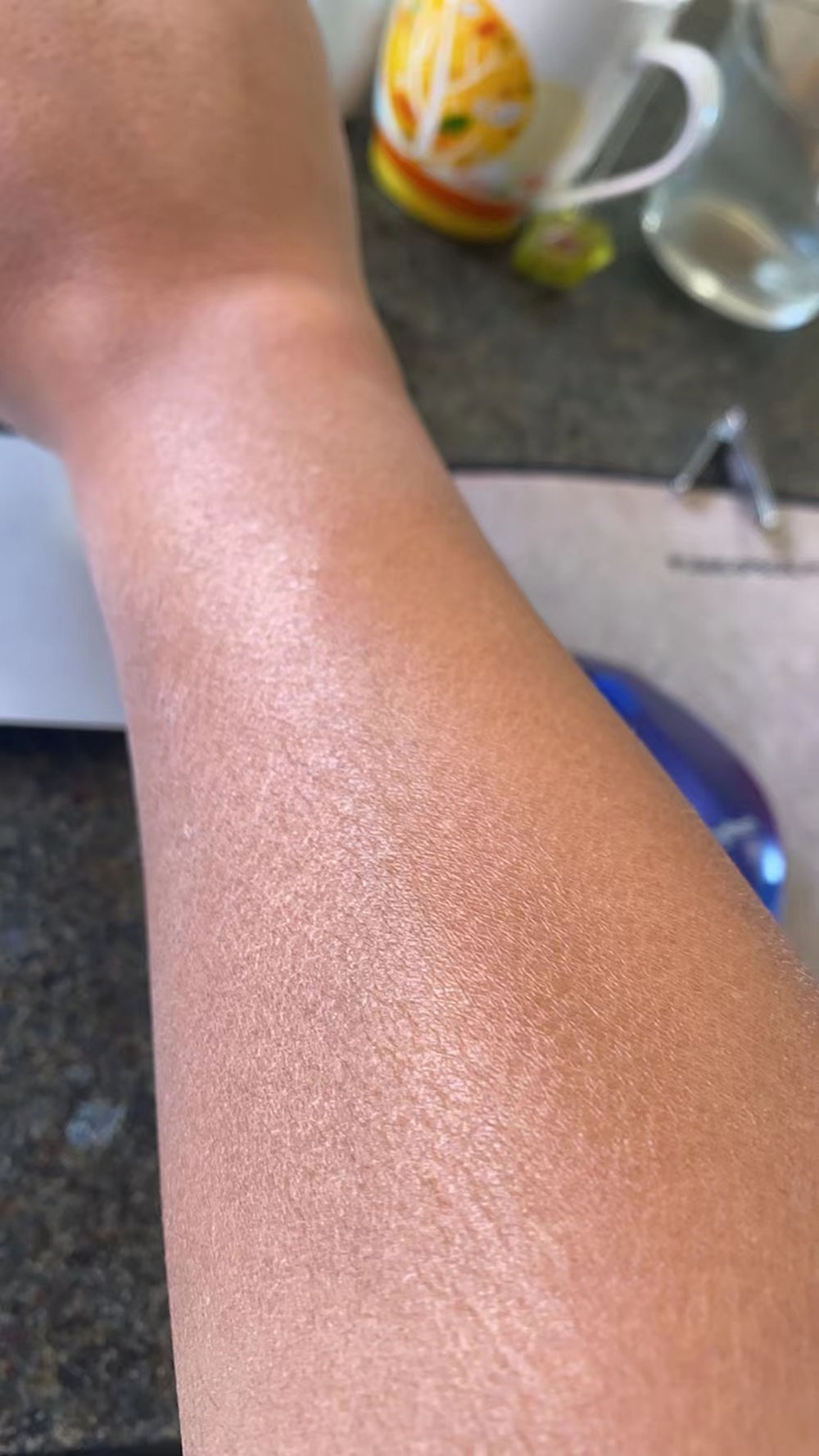 冬季皮肤干燥起皮有纹,皮肤干燥起蛇皮纹