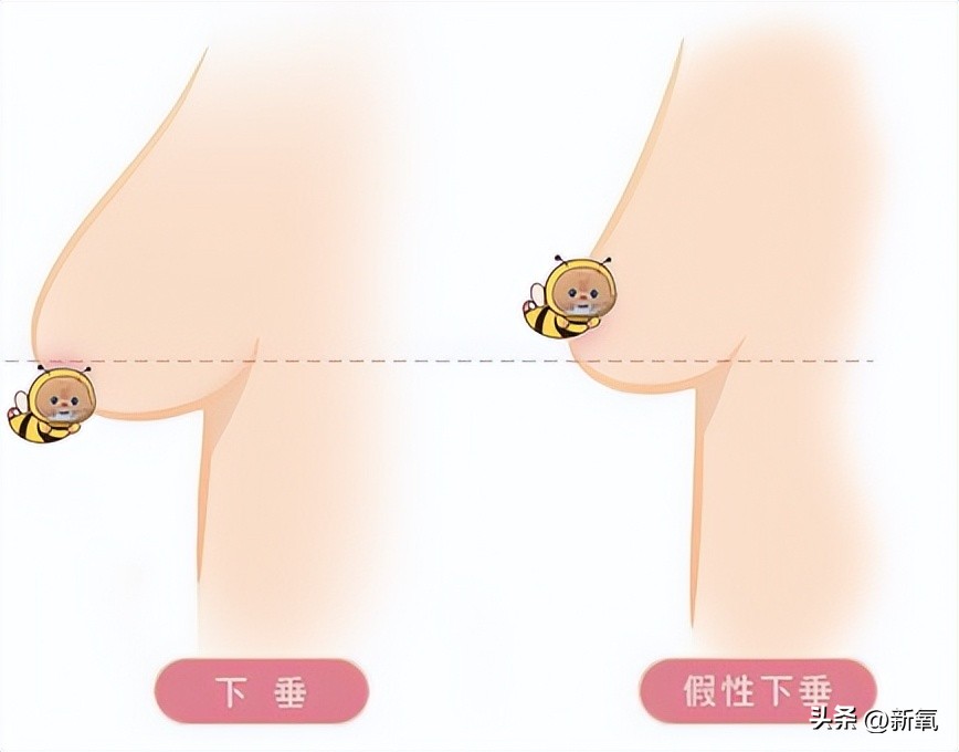 胸部明显大小不一怎么办,胸部越来越小是病理吗