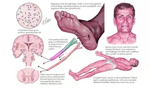 被猫咬出血超过24小时破伤风,有被猫咬了破伤风死亡案例吗
