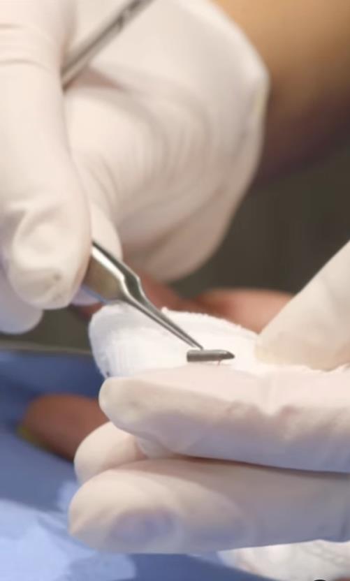 美国女子被橡皮子弹击中,女子手术取出戳20年铅笔芯