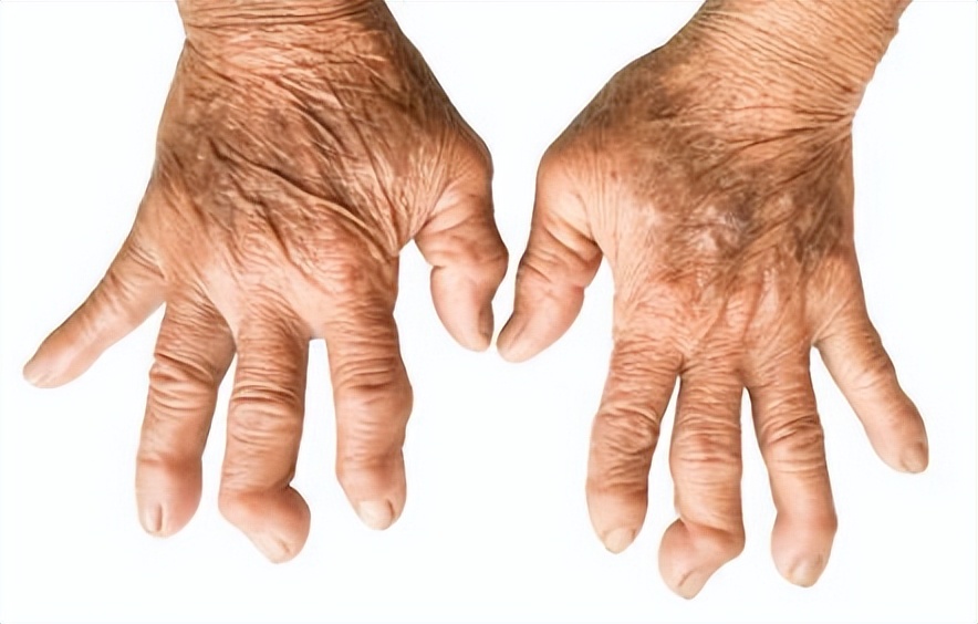 游走性关节痛是什么原因引起的,关节痛有哪些症状会影响到关节痛