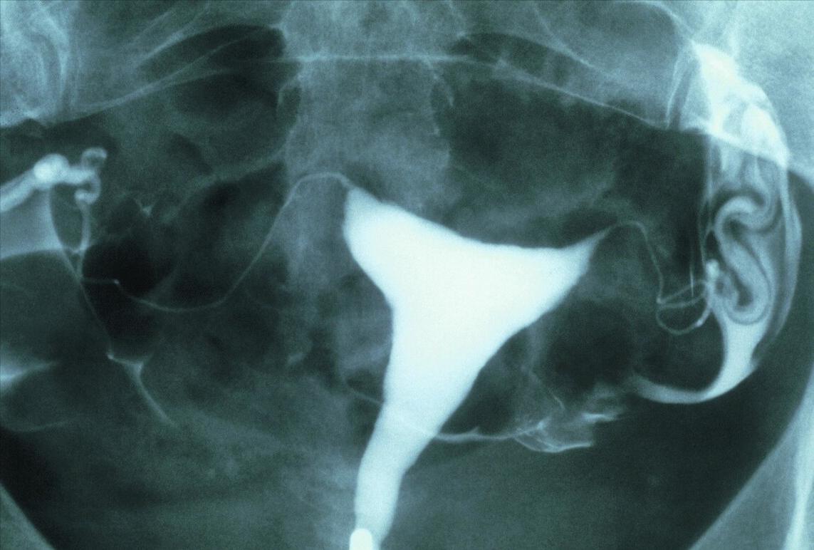 派特生物治疗方法,派特灵治疗妇科怎么用