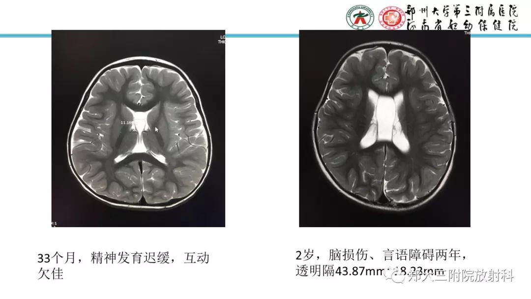 透明隔腔主要是判断什么,透明隔腔宽约10mm什么意思
