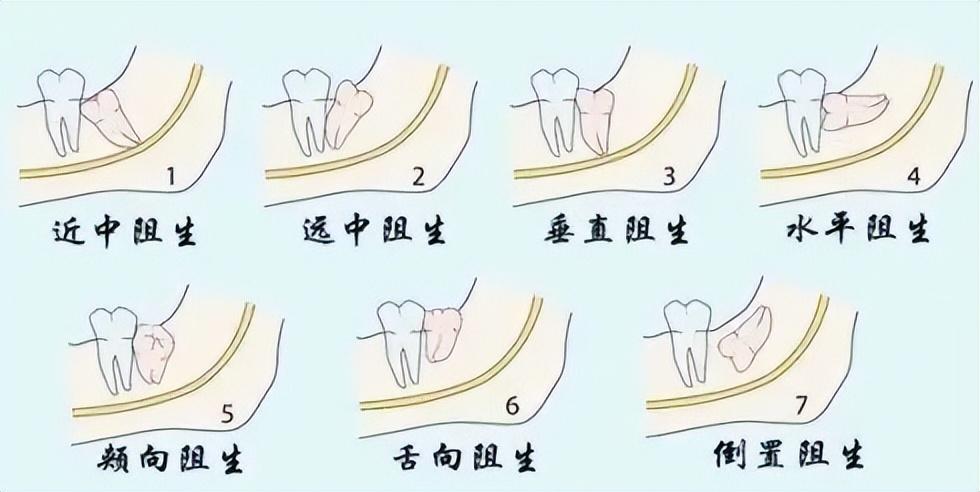 拔牙的危害有多大坏牙可以补吗,拔牙后不补的原因及危害