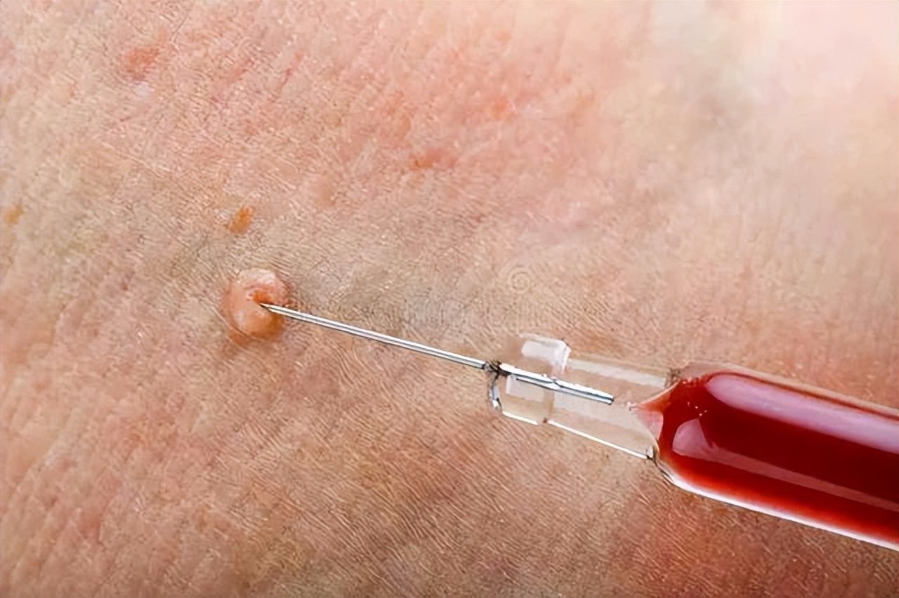 皮肤下长了小肉球如何去除,皮肤长小肉球用什么药膏