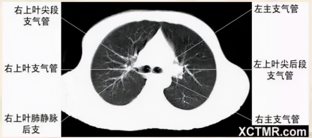 胸腹部盆腔ct主要检查什么,女性盆腔ct断层解剖结构图