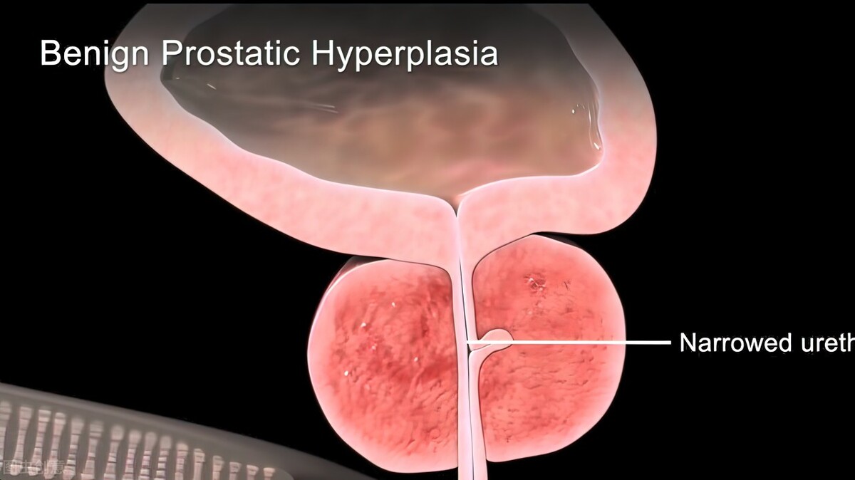 特拉唑嗪治疗前列腺肥大会反弹吗,国家医保新药降价