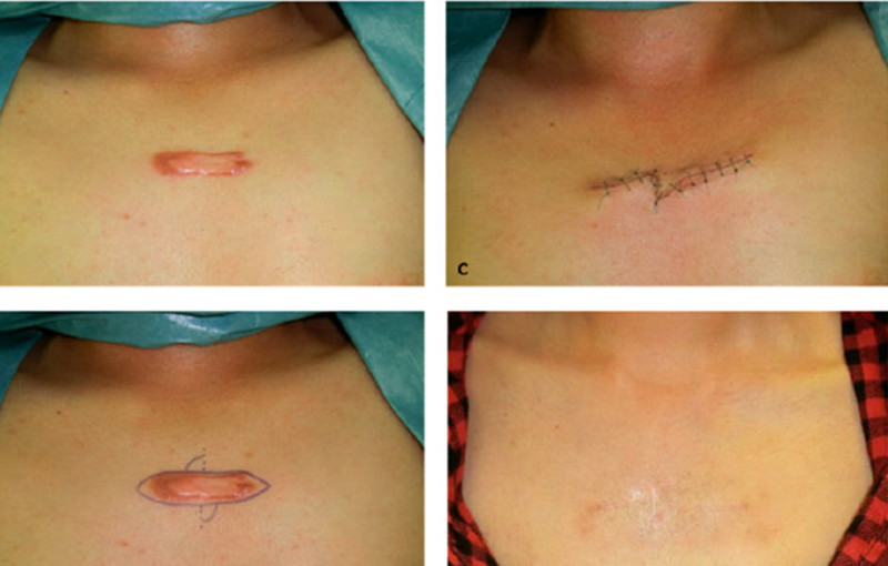 像个“小肉球”似的增生疤痕，是不是无药可救了？医生这样说：