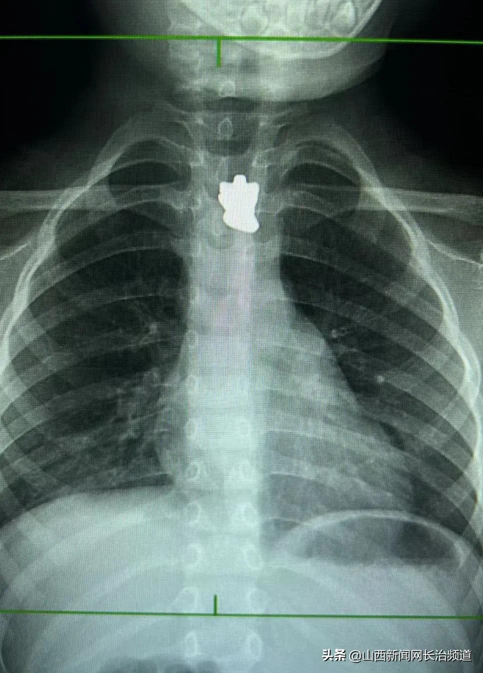 一岁宝宝拍胸片有辐射么,刚出生孩子照胸片