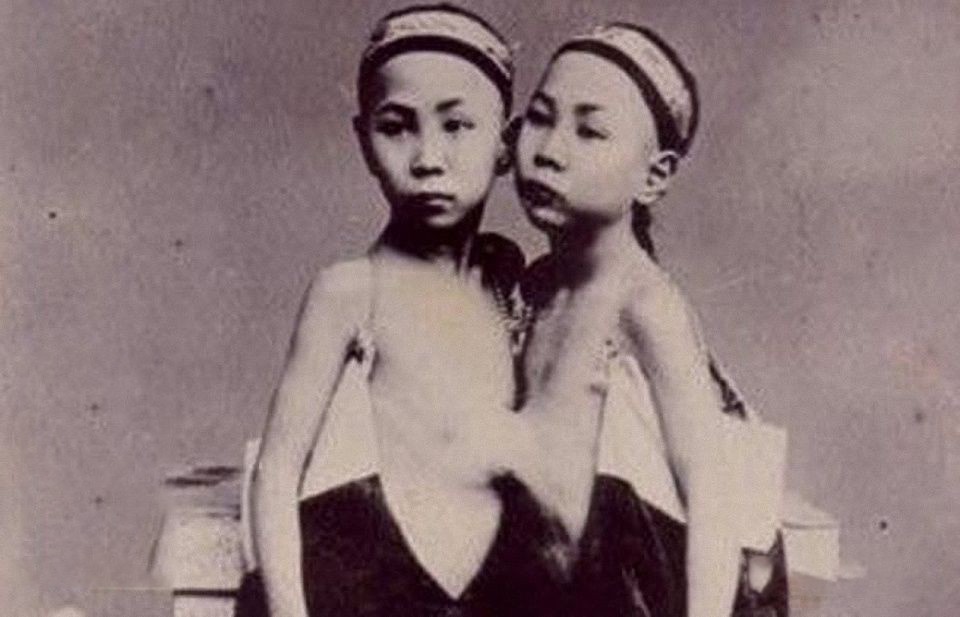 连体人娶妻生子,连体人如何生子