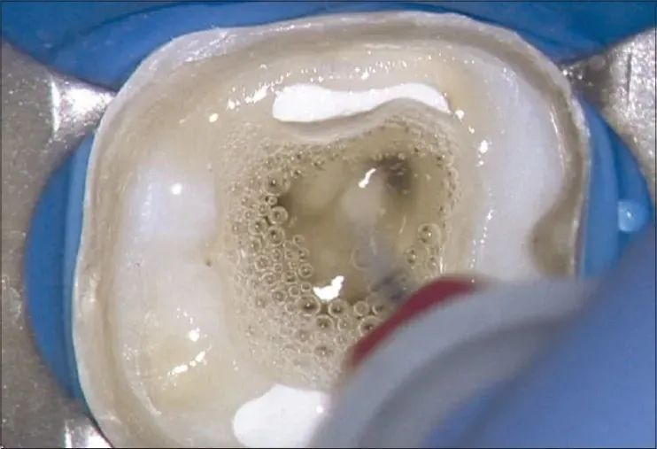 抽神经是什么感觉,抽神经的时候有没有后悔过