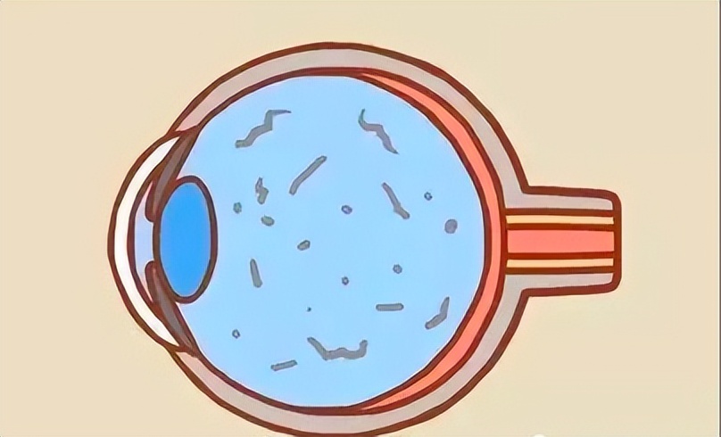 科普一分钟眼睛有闪光感需重视,眼睛闪光感能自己治愈吗