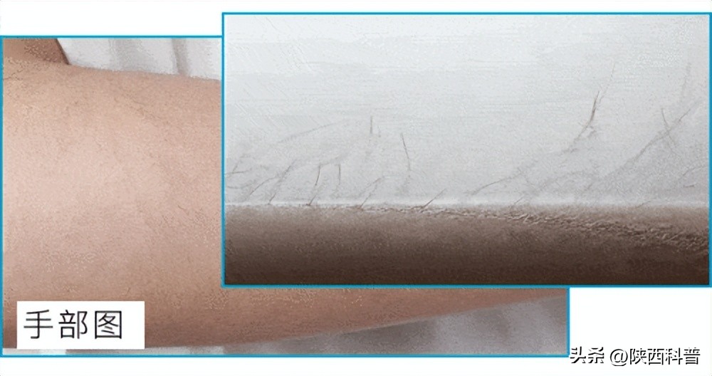 腋毛脱毛好还是刮掉好,腋毛永久去除会不会影响腋下排汗