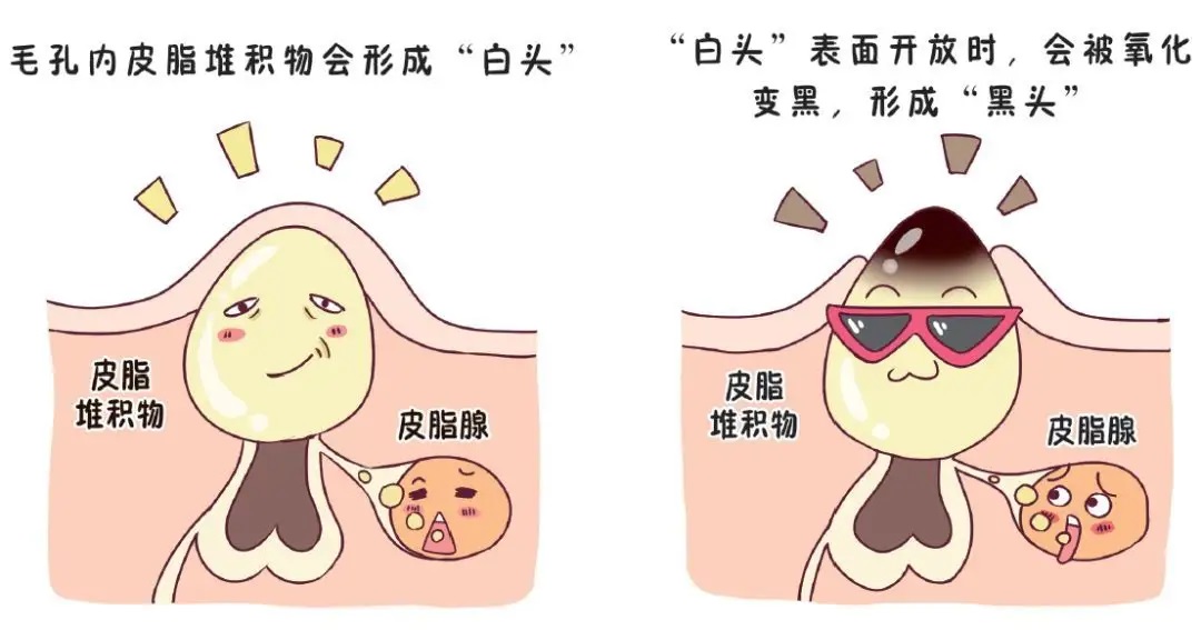 简单实用有效去黑头的方法,如何用简单的方法去黑头真实有效